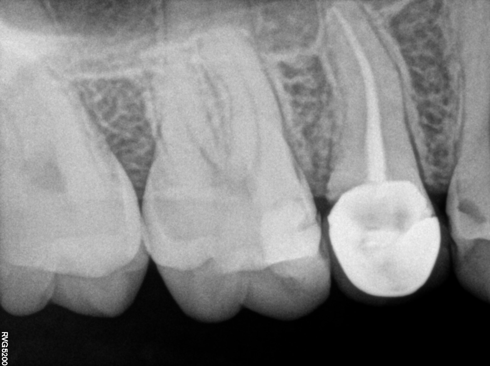 Dental X-ray
